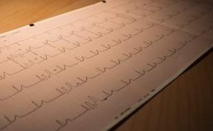 هوش مصنوعی می‌تواند با تحلیل نوار قلب، بیماری‌های ساختاری قلب را شناسایی کند